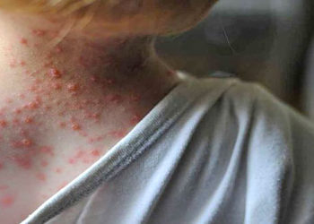 Dentro de la población en general, los niños son los más susceptibles de ser infectados por el virus.