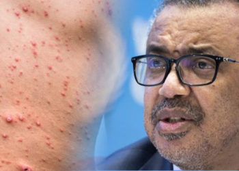 Director de la OMS, Tedros Adhanom, toma decisiones con más lentitud, que la rapidez con la que aumentan casos de viruela del mono en el mundo.
