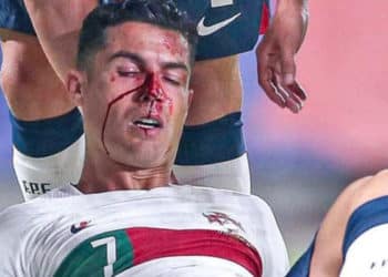 La imagen de Cristiano Ronaldo ensangrentado causó alarma entre la fanaticada, a escala planetaria.