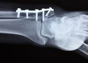 El 80% de los 10 millones de estadounidenses con osteoporosis son mujeres.